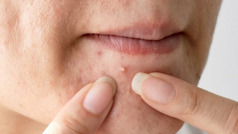 Các loại thuốc uống và bôi trị mụn trứng cá, mụn cóc hiệu quả